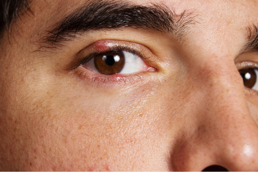 Natural Approach to Styes