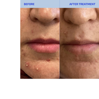 Thumbnail for SHAANT Skin De-Stress Supplement 2.0 for Hormonal Acne