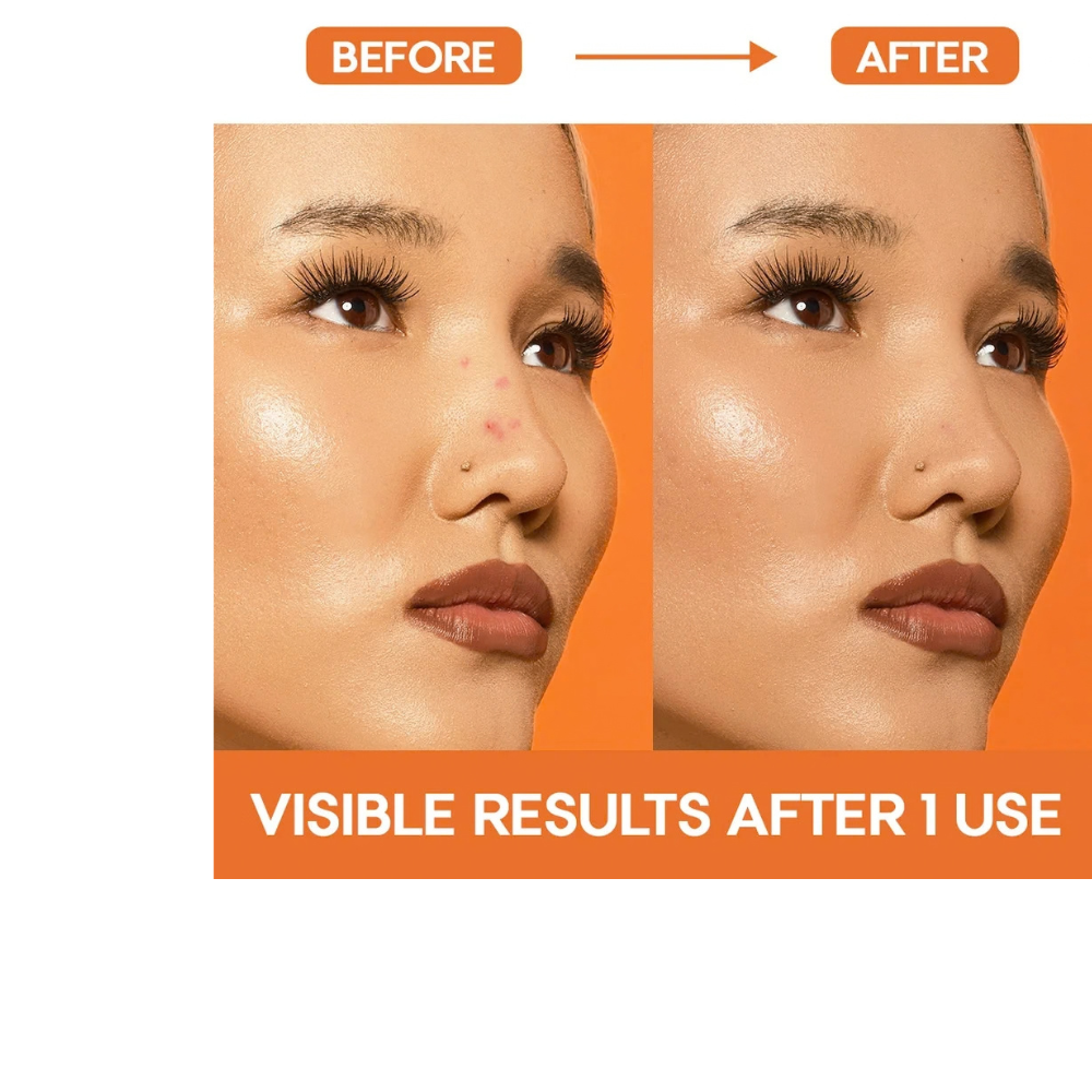 EZAcne Pimple Patches – Nose