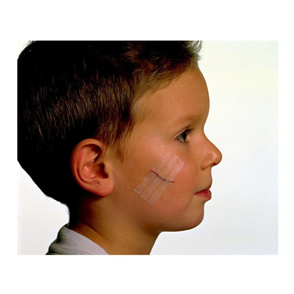 Nexcare Steri-Strip Skin Closure, Hypoallergenic