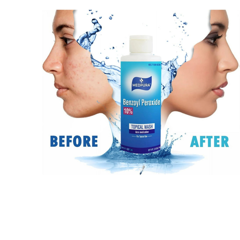 Benzoyl Peroxide - 10%